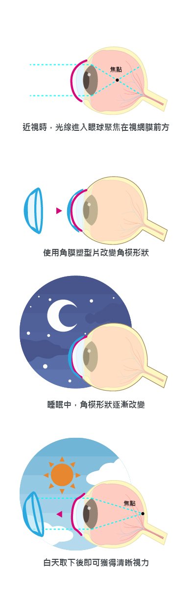 角膜塑型圖片說明